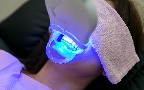 歯科医院のホワイトニング効果
